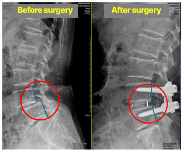 수술전 4요추가 전방으로 미끄러진 상태에서 고정되어 복구됨