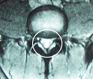 정상 척추관 MRI