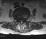 수술전 MRI 사진
