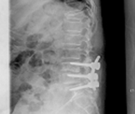 수술후 일반 X-ray 사진