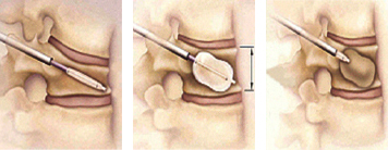 척추 후만 성형술의 모식도: 그림과 같이 척추의 압박을 원형으로 복원하고 시멘트를 충전하여 등이 굽음과 허리 통증을 치료합니다