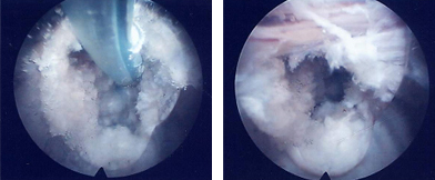 내시경 수술 장면: 고주파나 레이저료 제거된 디스크를 마무리 하는 모습
