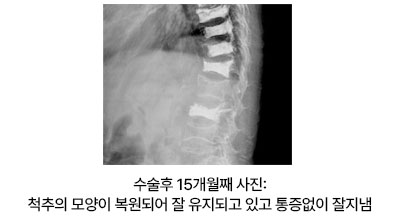 수술후 15개월째 사진: 척추의 모양이 복원되어 잘 유지되고 있고 통증없이 잘지냄