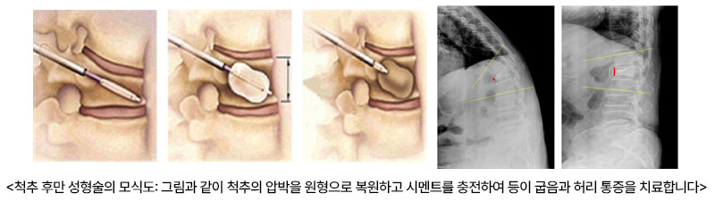 척추 후만 성형술의 모식도: 그림과 같이 척추의 압박을 원형으로 복원하고 시멘트를 충전하여 등이 굽음과 허리 통증을 치료합니다