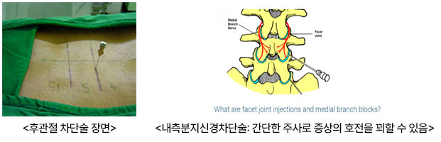 후관절 차단술 장면, 내측분지신경차단술: 간단한 주사로 증상의 호전을 꾀할 수 있음