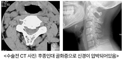 수술전 CT 사진: 후종인대 골화증으로 신경이 압박되어있음