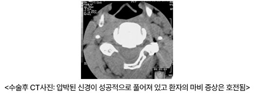 수술후 CT사진: 압박된 신경이 성공적으로 풀어져 있고 환자의 마비 증상은 호전됨