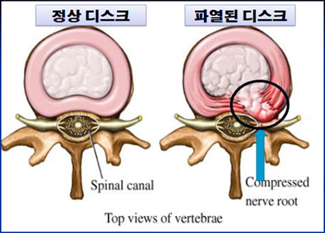 정상 디스크와 파열된 디스크의 이미지