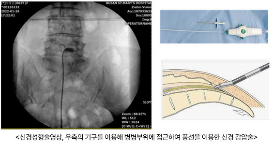 신경성형술영상, 우측의 기구를 이용해 병병부위에 접근하여 풍선을 이용한 신경 감압술