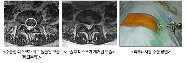 수술전 디스크가 뒤로 돌출된 모습(타원부위), 수술후 디스크가 제거된 모습