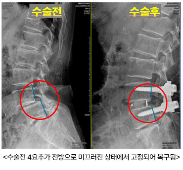 수술전 4요추가 전방으로 미끄러진 상태에서 고정되어 복구됨