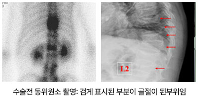 수술전 동위원소 촬영: 검게 표시된 부분이 골절이 된부위임
